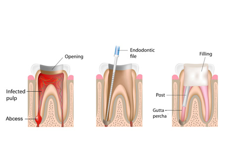 Root canal treatment